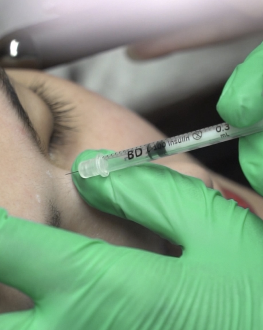An anti-wrinkle injection with Xeomin at Skinstitute MD