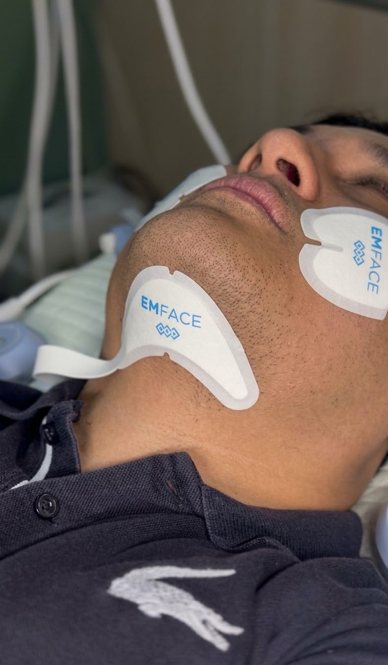 EmFace applicator placement for forehead, cheeks, undereyes, and submentum.