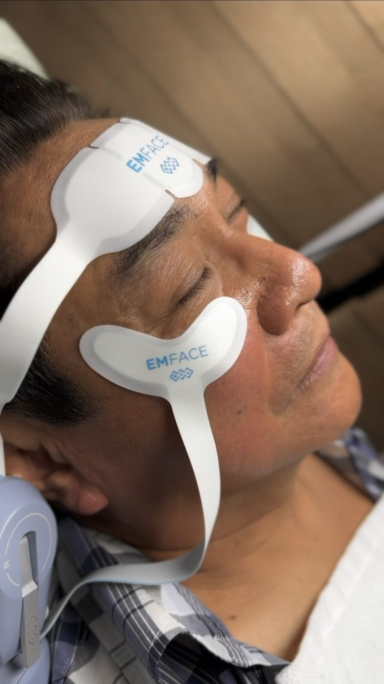 EmFace applicator placement for forehead, cheeks, undereyes, and submentum.