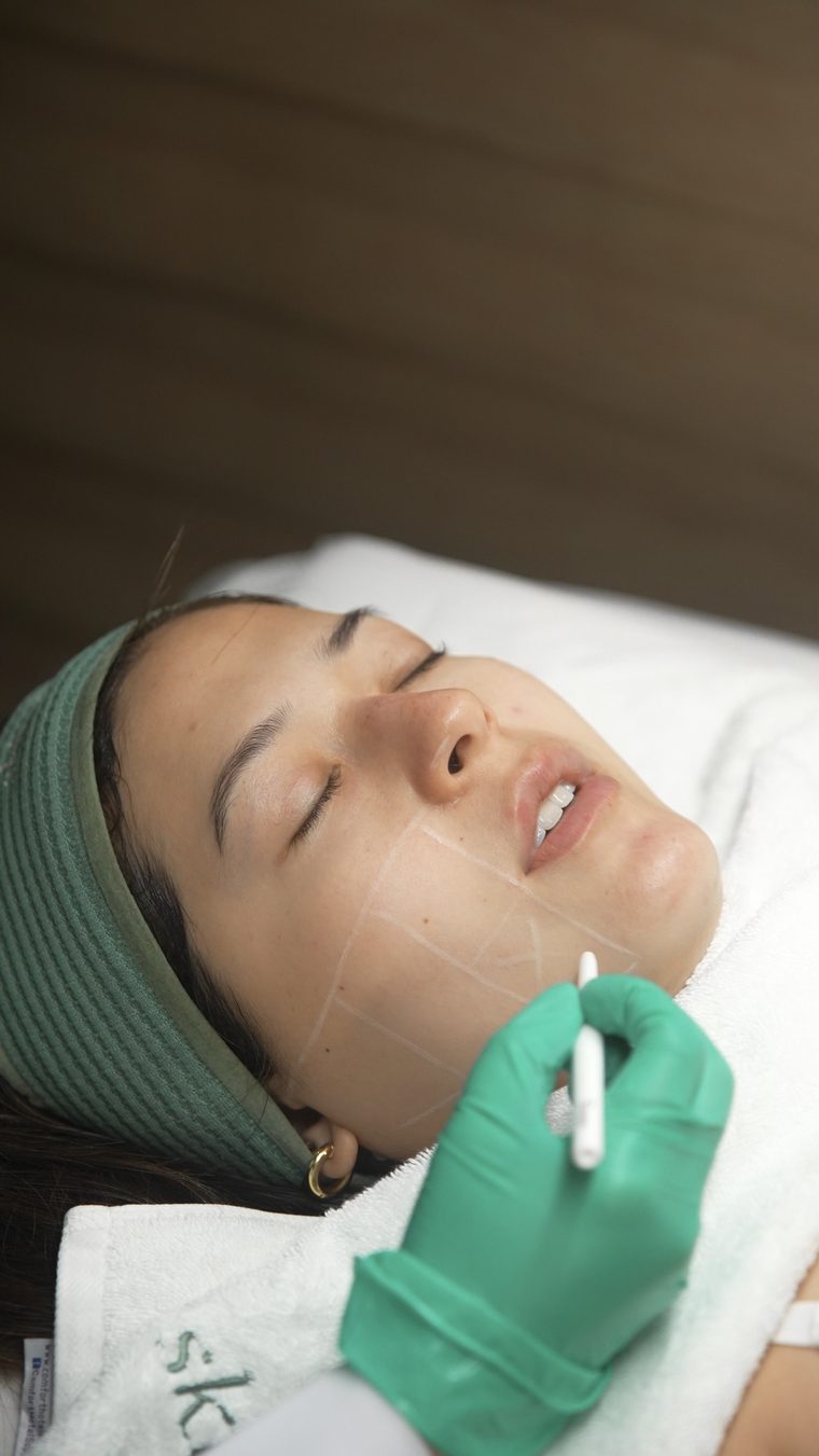 A doctor at Skinstitute marking the treatment areas on a patient's face before Ultherapy PRIME