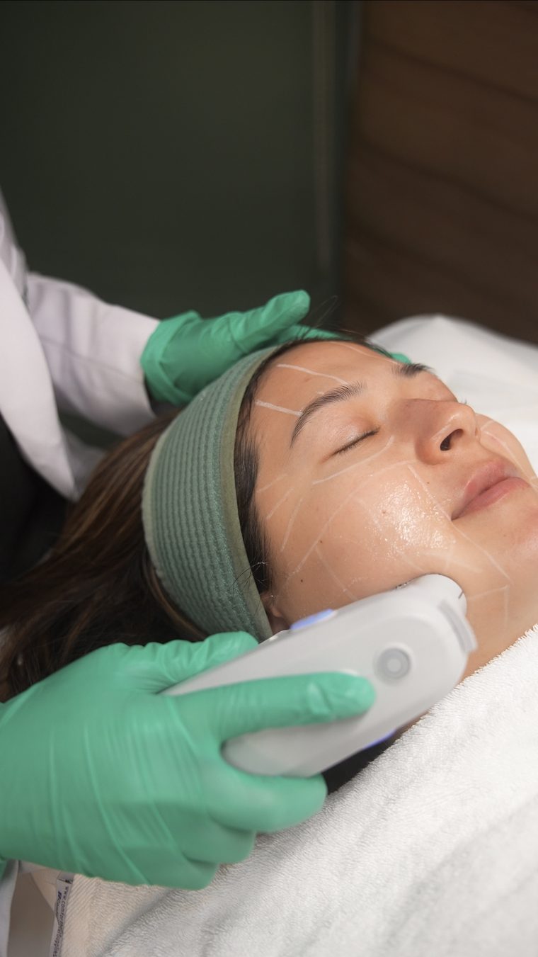 Patient receiving Ultherapy PRIME at Skinstitute, with the treatment areas marked on her face